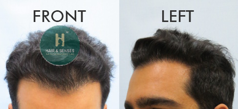 Hair Growth after 10 Months